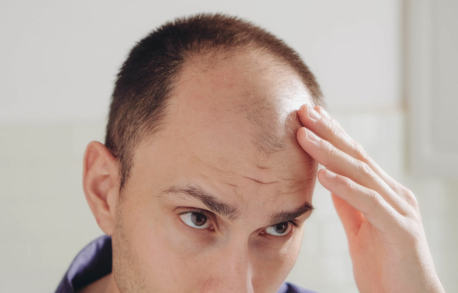 Why Do Men Go Bald And How To Treat Hair Loss Dense Hair Experts 