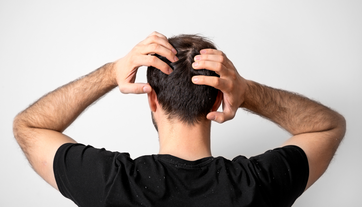 Top 3 Causes of Hair Loss
